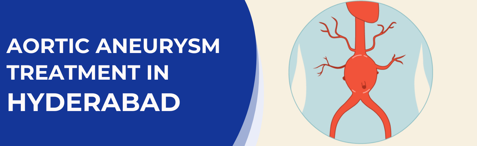 Aortic Aneurysm Treatment in Hyderabad